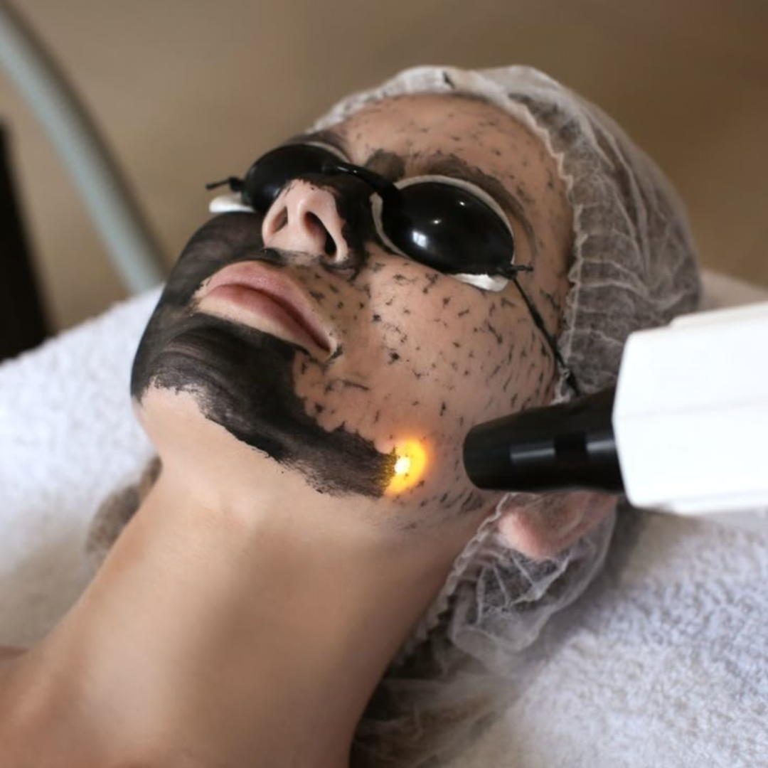 Laser Carbon Treatment