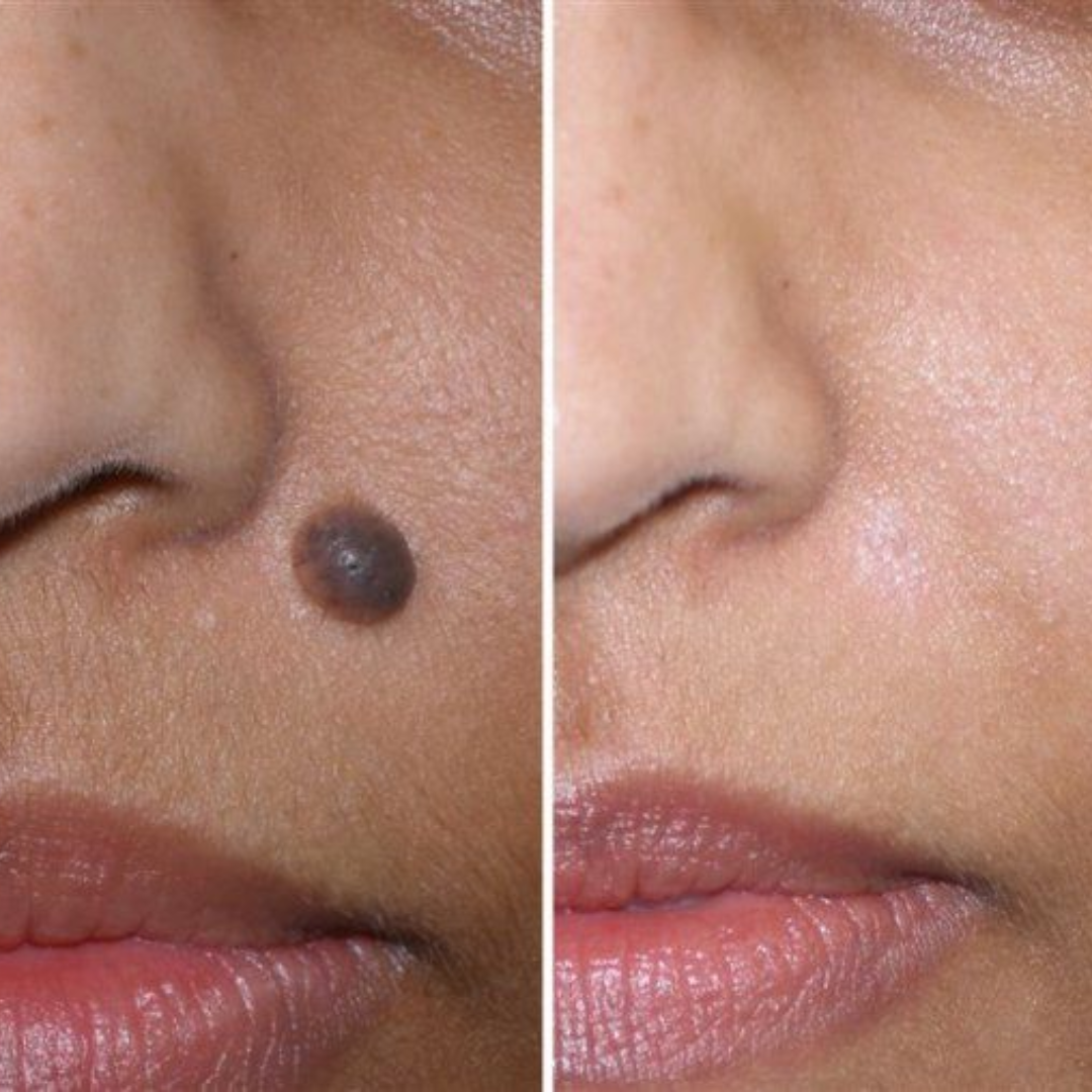 Mole Removal