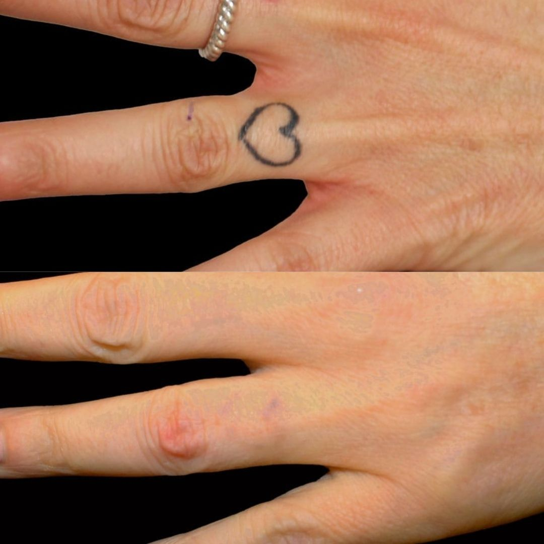 Laser Tattoo Removal