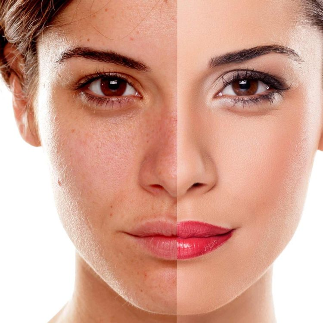 Pigmentation Skin Treatment
